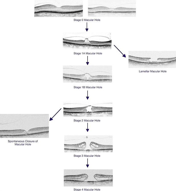 macularhole