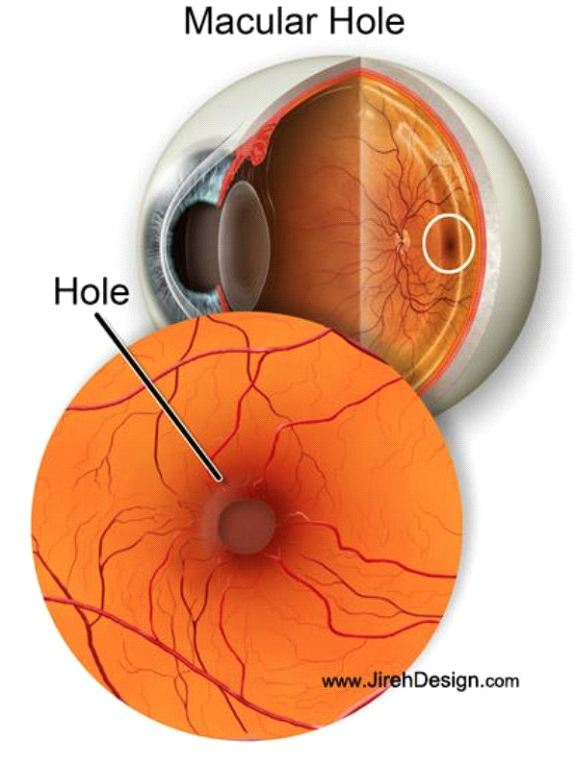 MacularHole